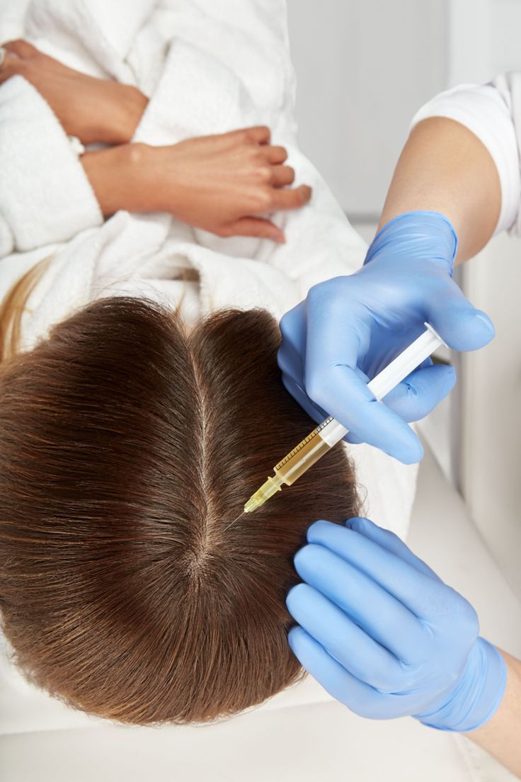Mesoterapia Capilar
